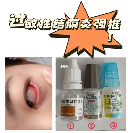 可是我并不知道这是过敏,就在小诊所开了左氧氟沙星滴眼液,红霉素眼膏