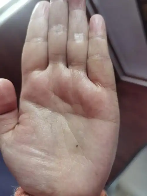 女人左手手背上有痣好吗