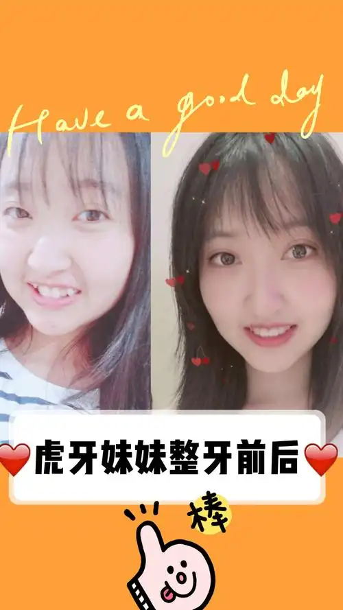 虎牙妹妹矫正前后对比