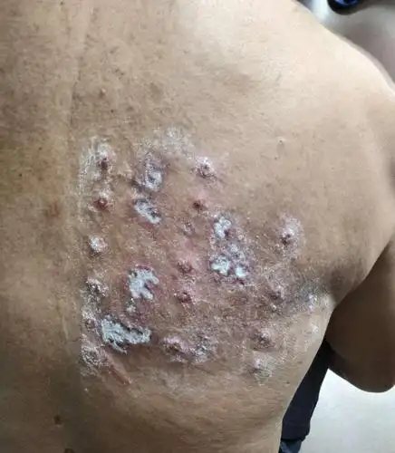 老爸后背长蛇胆疮了,疼得不得了,有什么办法吗?