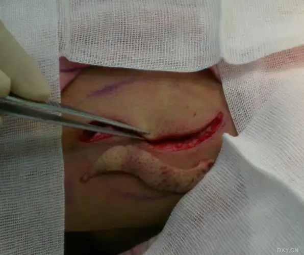 【 资源】背部脂肪瘤切除—真皮瓣填充
