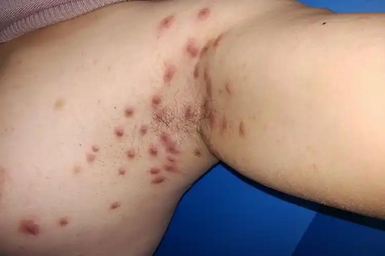 疥疮图片和症状怎么治疗_有来医生