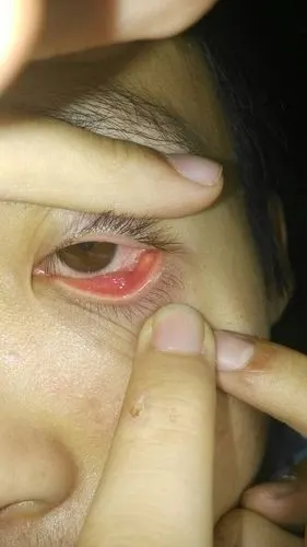 眼睛上长了个疙瘩,这是啥状况,略疼,求问