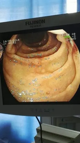 内镜下的争分夺秒,巧夺天工!