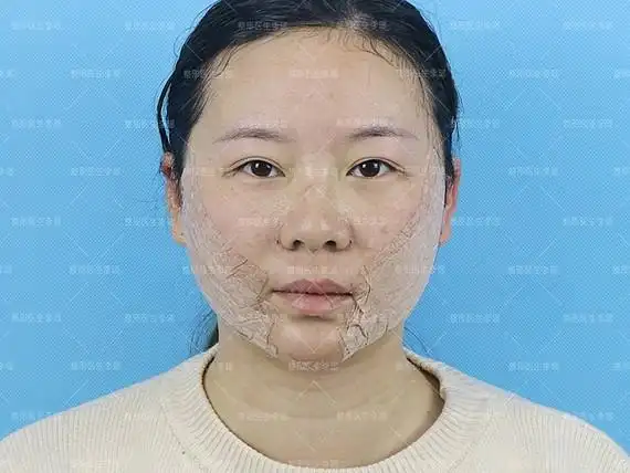 面部吸脂会让皮肤松弛下垂?