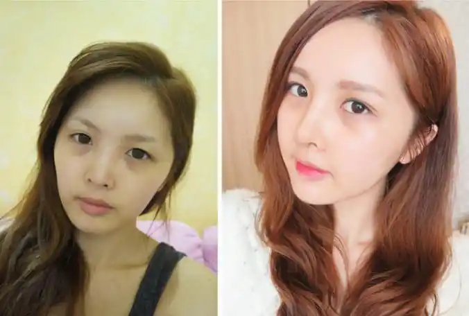 韩国脂肪填充对比