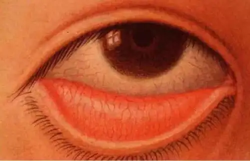 克迈润霏:如何快速知晓自己是否贫血?