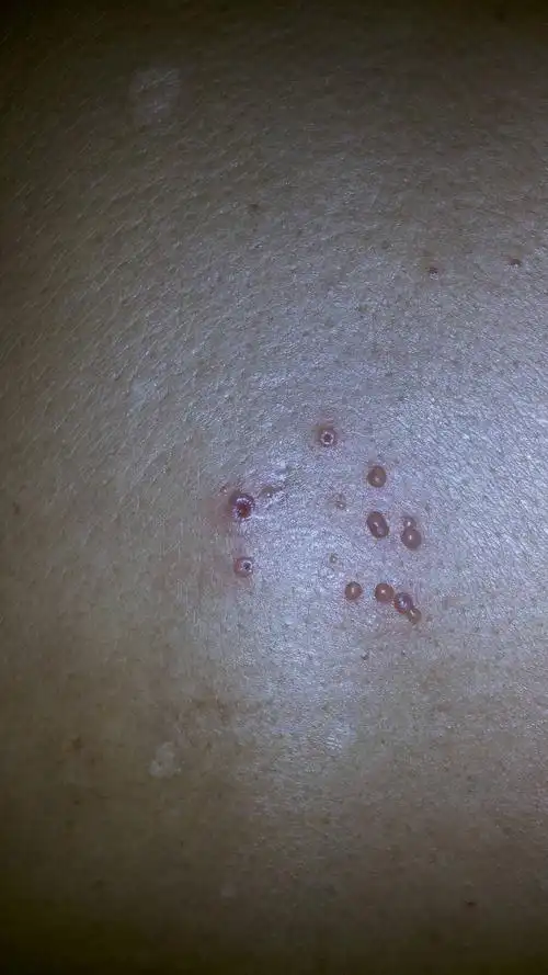 没在意!今天我们一看背后起了好多小脓包!