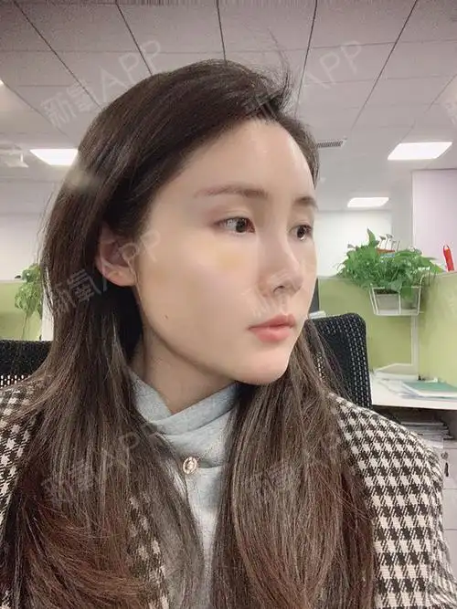 全面部脂肪填充脸上还有些许的青肿,还在恢复,也还好,并不影响上班