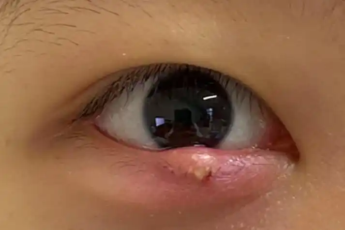 睑板腺炎眼睑硬疙瘩图