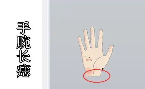 手腕长痣