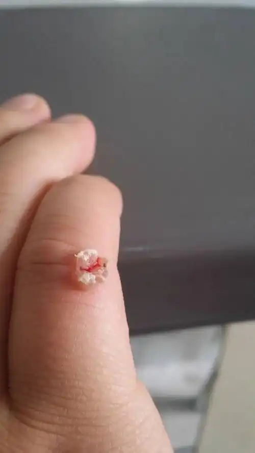 手上长个肉疙瘩,会长大,指甲刀剪了后还是会长出来,这是什么东西