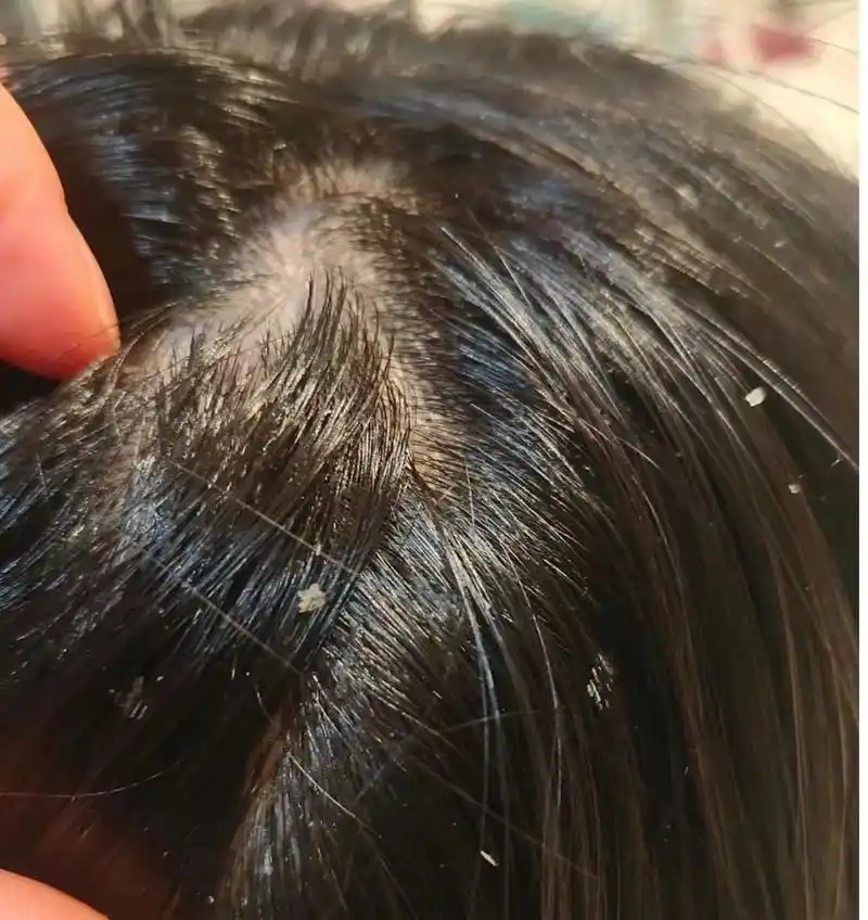 你们知道吗,我老公以前总是被头皮屑问题困扰,不仅在他的衣服上,枕头