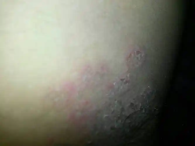 我是男性 ,大腿内侧起红疹,痒痒的会是艾滋病吗?