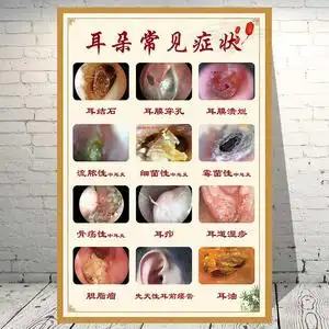 耳朵常见症状海报中医养生挂画经络理疗墙贴人体穴位结构挂图