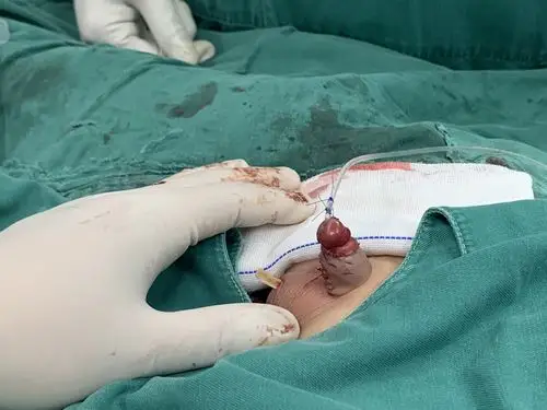 现在的外形看起来是不是和一个只仅仅做过包皮环切手术的正常人阴茎差