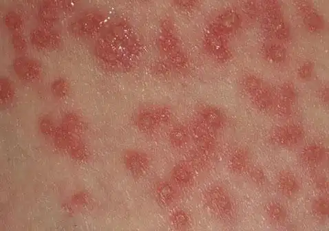 病毒性红斑是什么症状图片