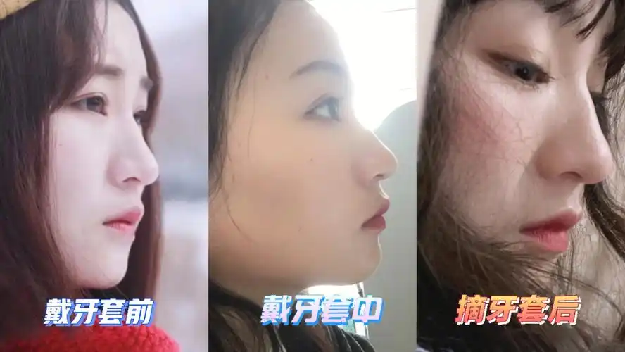 牙套  #侧脸  #整牙侧脸93 我看有人说看不出区别,那只能说给下颌