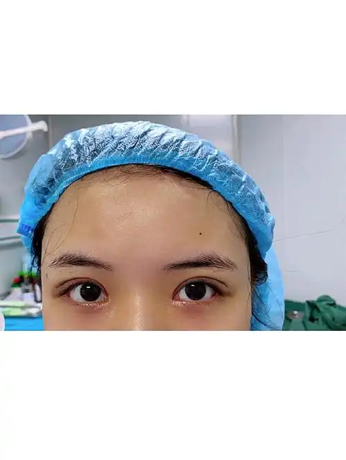 第一次双眼皮做的很不成功,肉条感一年了还是没有消除,心里特别难受