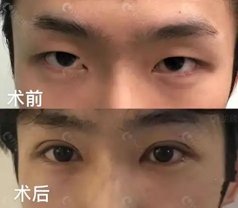 双眼皮手术前后对比照