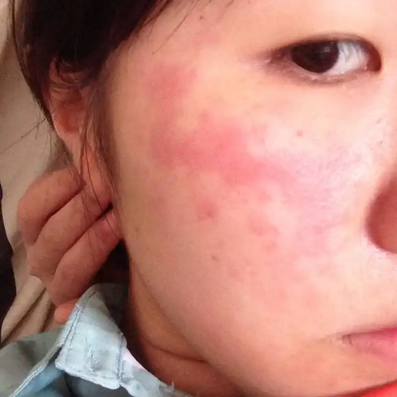 不知道脸过敏还是干嘛,昨晚擦了点雪花膏感觉有点刺痛就没有继续了