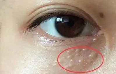 西安画美医疗美容医院-脸上长脂肪粒是什么原因