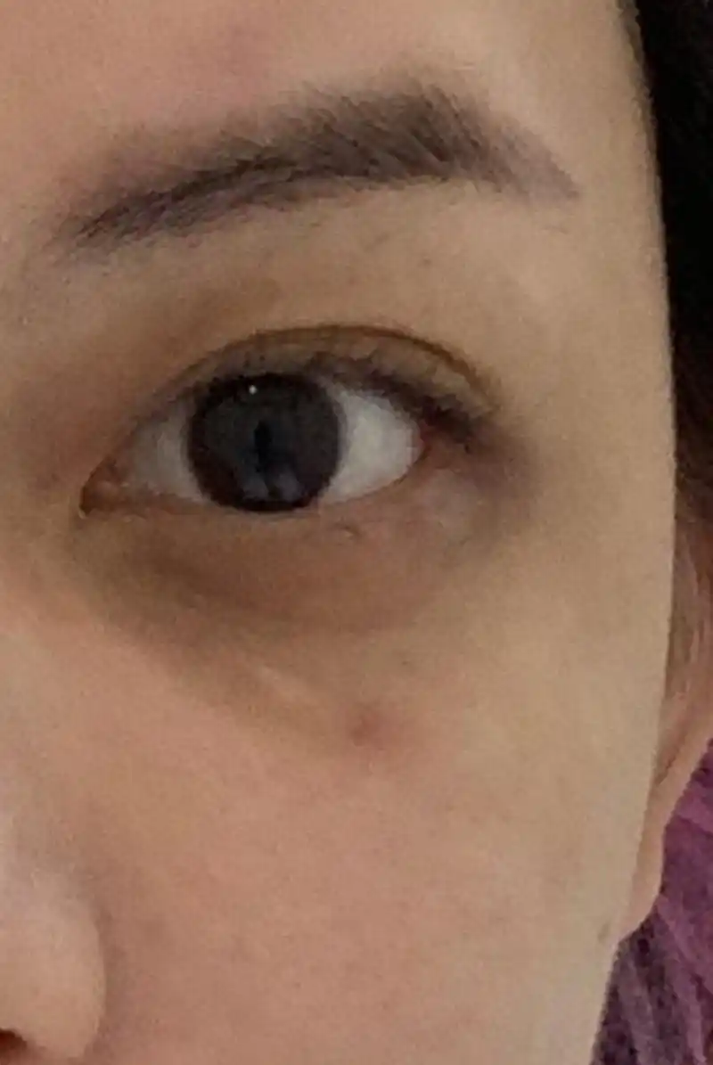 血管型黑眼圈可以从以下几方面改善:调整生活习惯,局部按摩,药物治疗