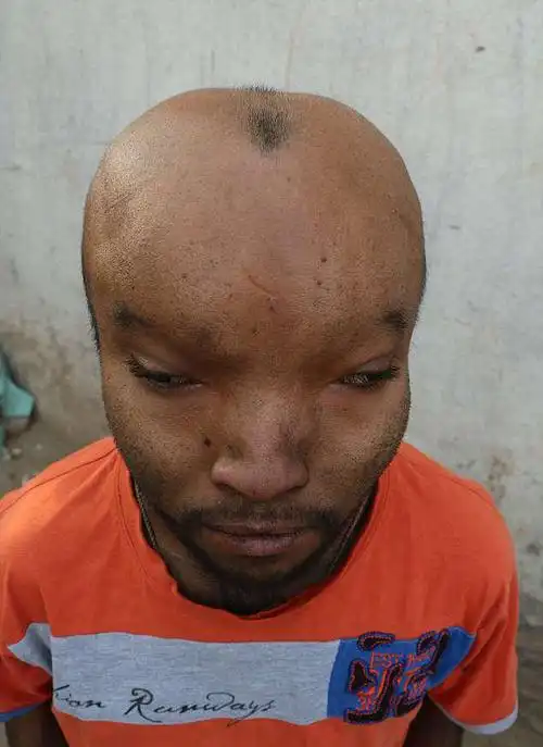 21岁印度男子患怪病,头部异常的巨大,如同"外星人"