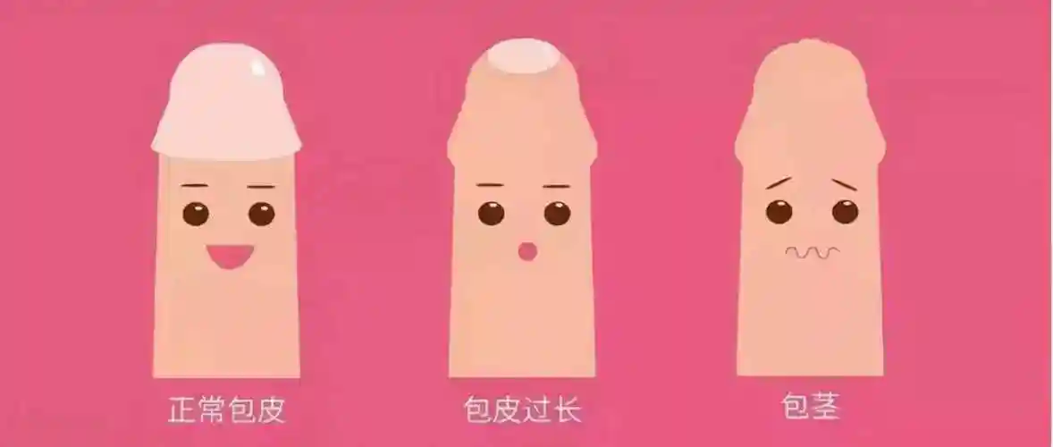 包茎怎么办无痛割包茎手术多少钱