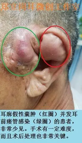 耳廓假性囊肿并先天性耳前瘘管感染手术广东佛山高明李 - 好大夫在线