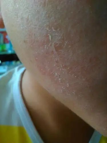 本人17,男,最近脸上总掉皮,还有那种摸起来粗糙的地方,在鼻子两侧