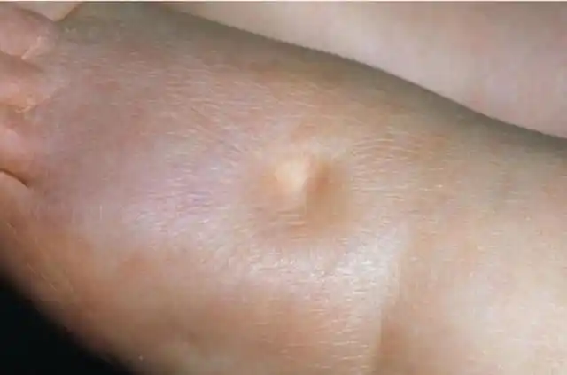 肾病综合征水肿