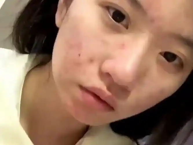 痘痘痘印一直在脸上好多年的女生有救了
