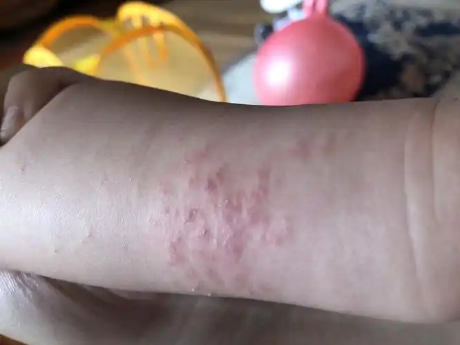 一个多星期了.摸了尤卓尔小药膏红霉素,怎么也不见下呢.