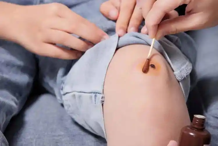 创口贴≠创可贴!无论哪种,用错了可能会截肢_伤口_处理_作用