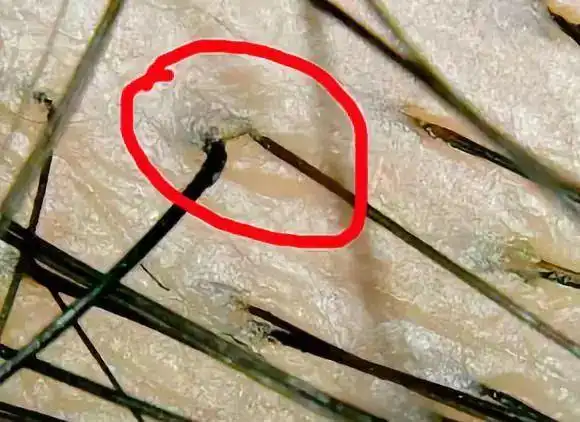 治脱发,这5个毛囊问题必须得了解!_头发