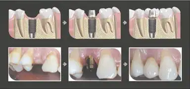 种植牙的过程