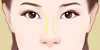 避雷指南丨如何选择适合自己的玻尿酸产品?