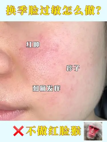 换季脸过敏?敏感肌护肤攻略,脸过敏必看