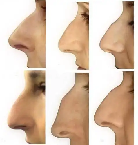 明星驼峰鼻好看?拉低颜值和财运的驼峰鼻还是去掉吧