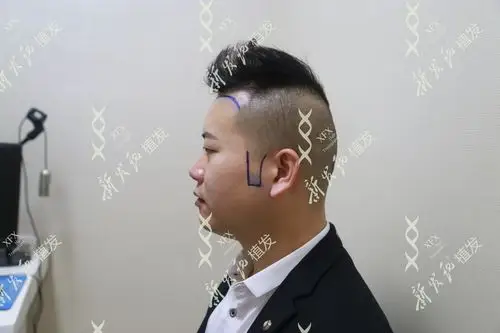 鬓角没长好,形象减分?黄先生鬓角种植成功案例