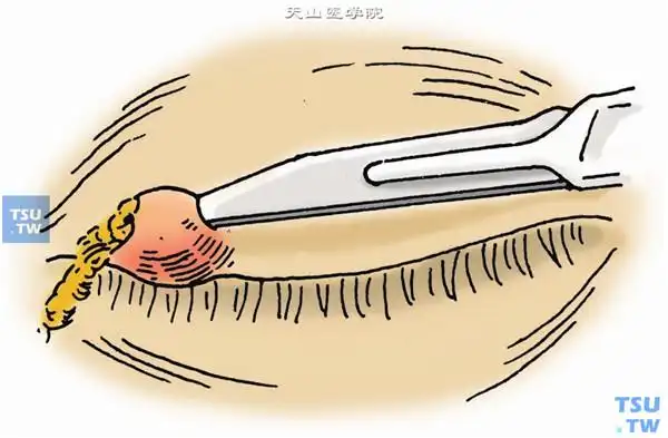 麦粒肿切开排脓术(针眼)步骤及临床经验