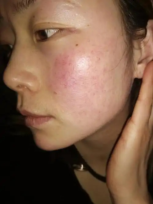 短期的红血丝:是面部毛细血管扩张的结果,并不是皮肤变薄.