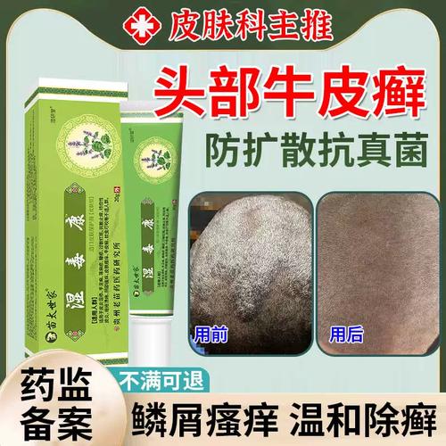 头皮癣药膏真菌感染头癣特药治疗银屑病头皮癣可效搭配软药膏pr