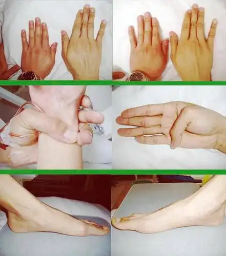 导致非凡天才殒命的危险疾病马凡氏综合征