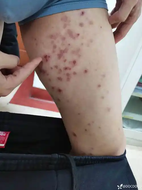 疱病多形红斑特应性皮炎