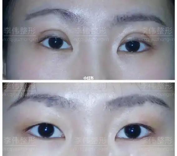 双眼皮_单眼皮_急救中心李伟_美妆_医美整形