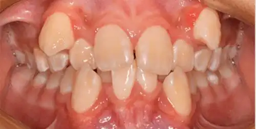 重度牙齿拥挤男孩:虎牙≠可爱!