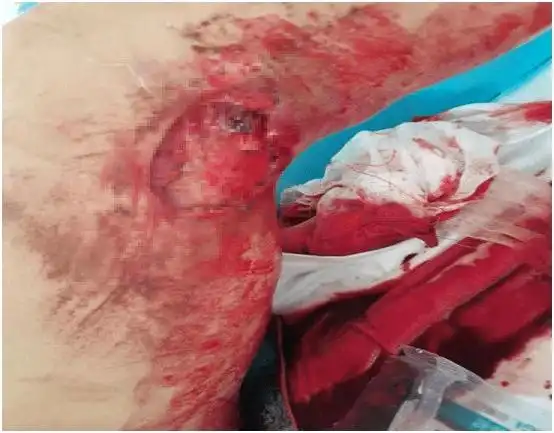 医院故事工地受伤险截肢9个诊断多次手术保腿成功