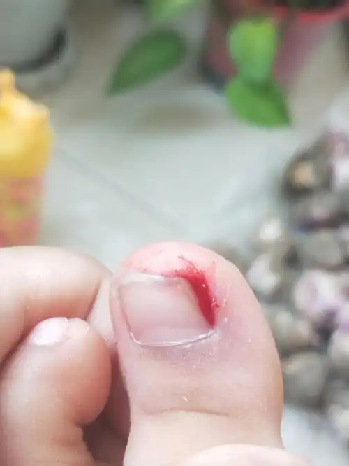 脚流血了好痛01